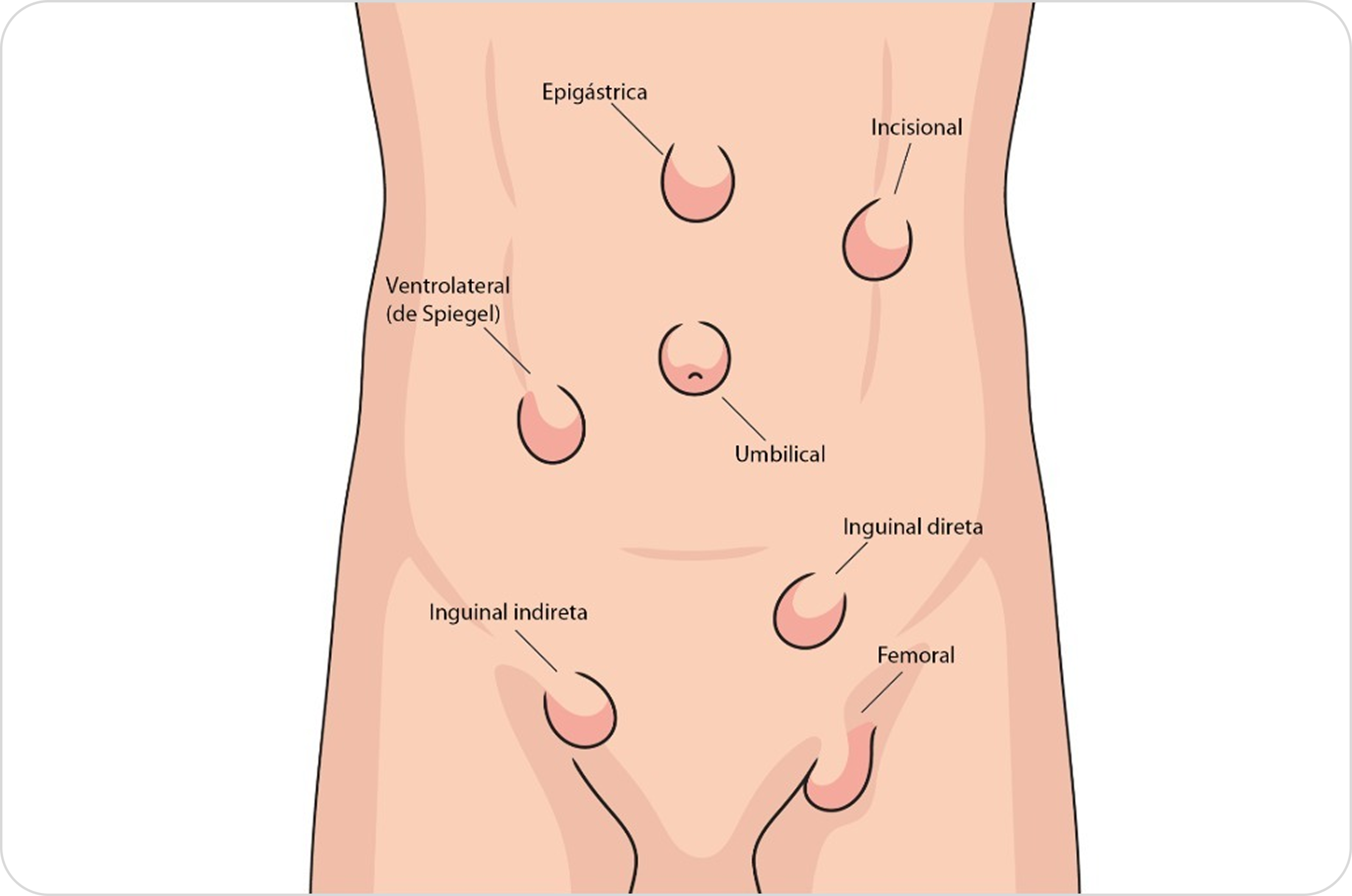 Cirurgia de hérnia de parede abdominal por videolaparoscopia – técnica minimamente invasiva