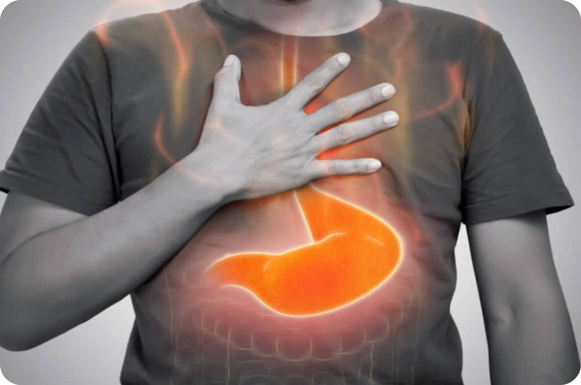 Tratamento cirúrgico de refluxo gastroesofágico e hérnia de hiato por videolaparoscopia