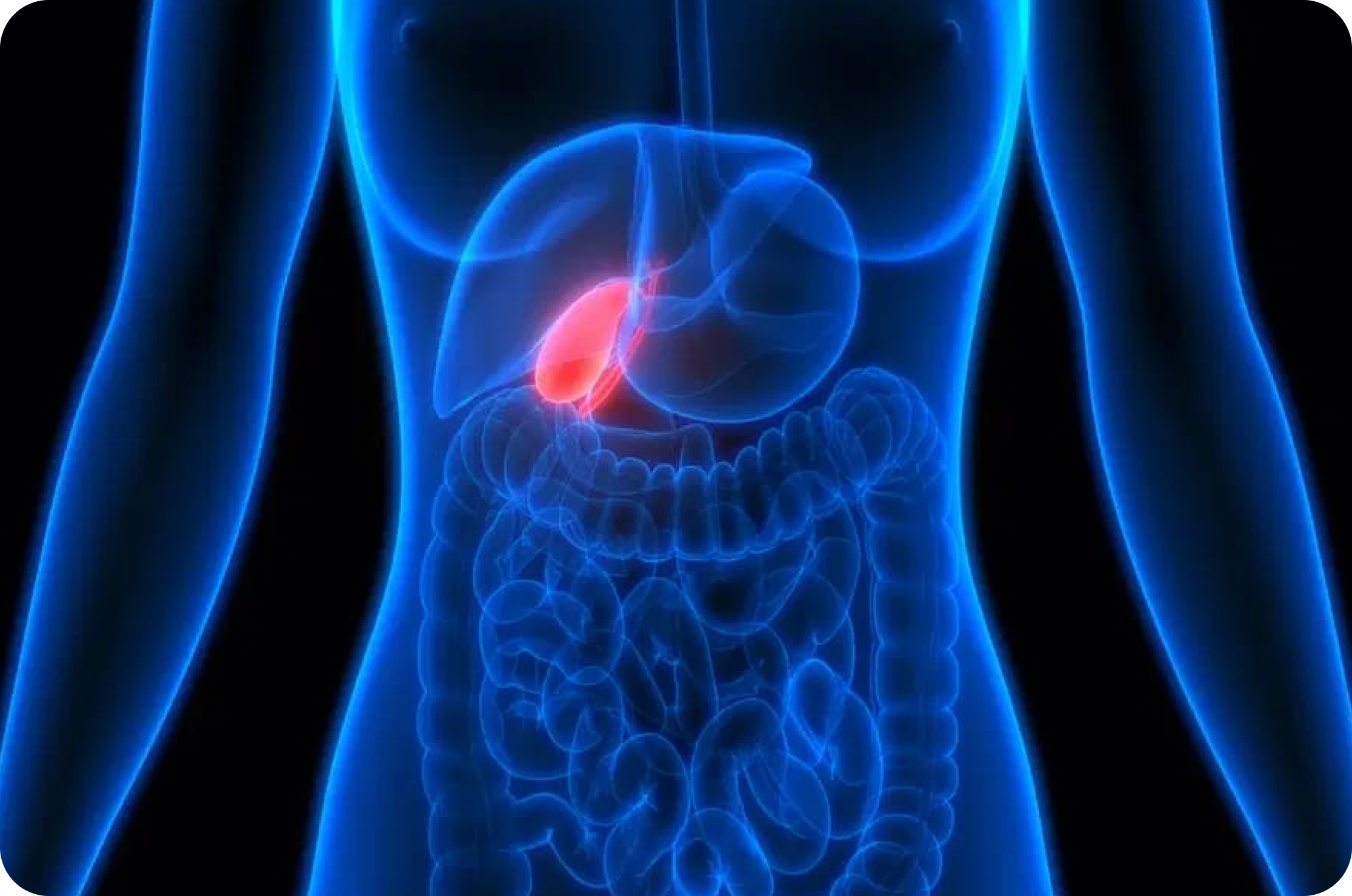 Colecistectomia videolaparoscópica – cirurgia de vesícula biliar para pedras e pólipos